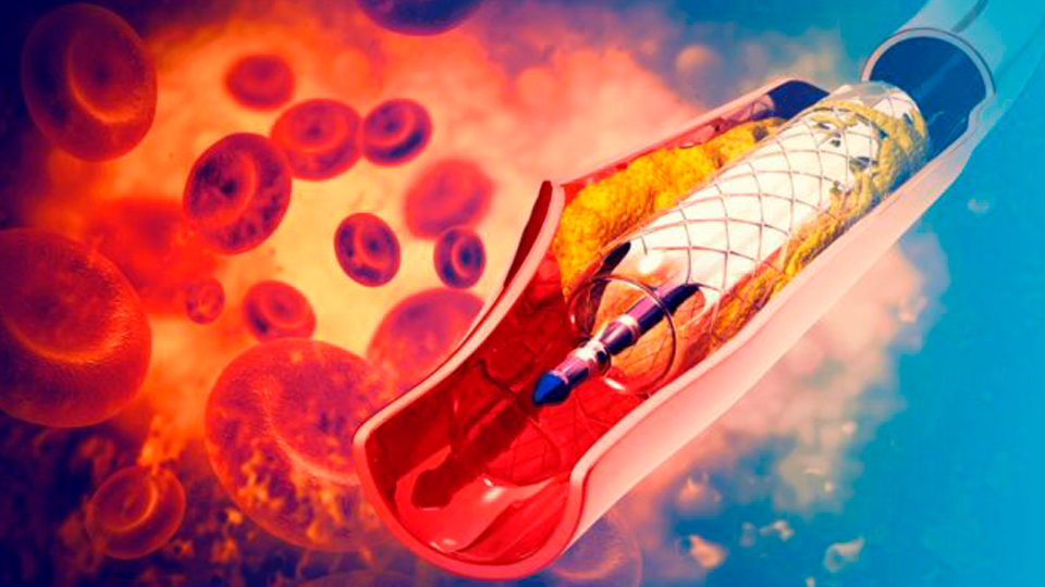 Impacto de la Técnica de Implante en la Disfunción Coronaria Microvascular | Grupo i2